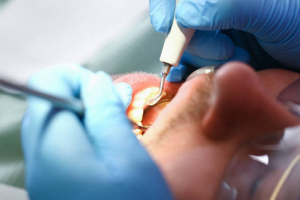 Best Emergency Gum Treatment in Larkspur, CA